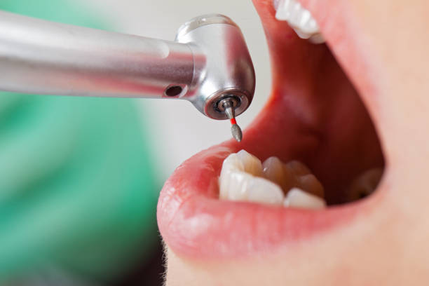 Best Emergency Tooth Extraction in Gentry, AR